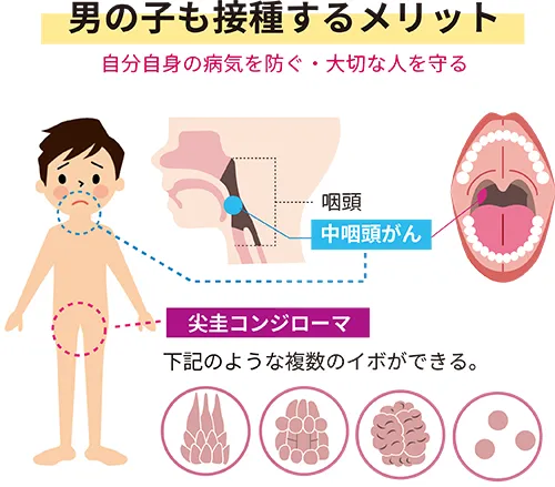 男の子も接種するメリット（自分自身の病気を防ぐ・大切な人を守る）
